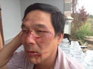 Ông Lê Đình Lượng bị đánh đập gây thương tích. Nguồn ảnh: Fb Trần Khắc Đạt.