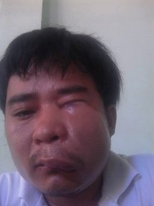 Actitivst Nguyen Van Thanh beaten by police in Danang City on June 5, 2016