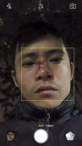 Blogger Dinh Hong Quyen with broken nose after being assaulted by plainclothes agents